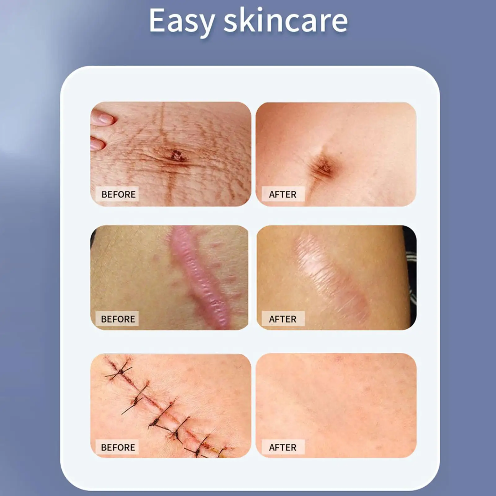 {title} on skin — soft, self-adhesive silicone scar sheet – view 2